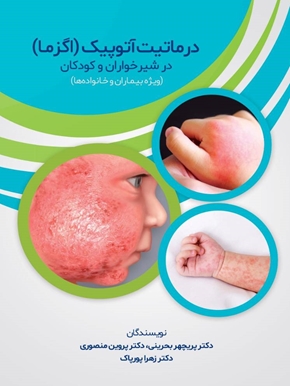 درماتیت آتوپیک (اگزما) در شیرخواران و کودکان